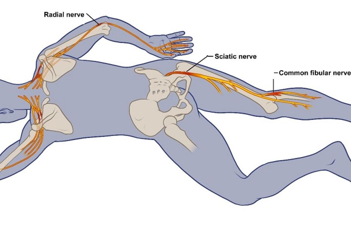 PostCOVID19 Nerve Damage Rehabilitation Highlighted in NYT